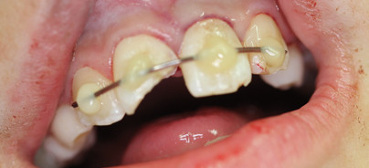 Frontzahntrauma bei jugendlichem Patient