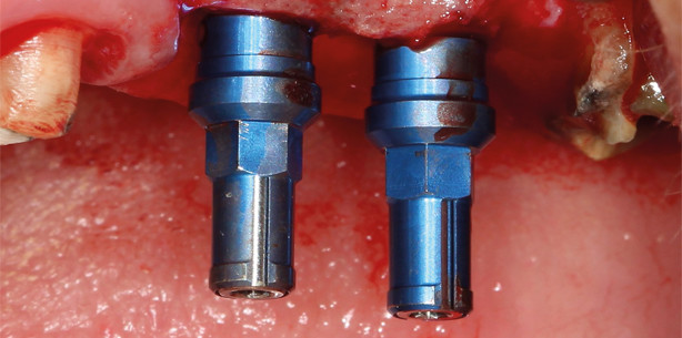 Implantation und Kieferkammaugmentation: Ein Fallbericht