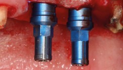 Implantation und Kieferkammaugmentation: Ein Fallbericht