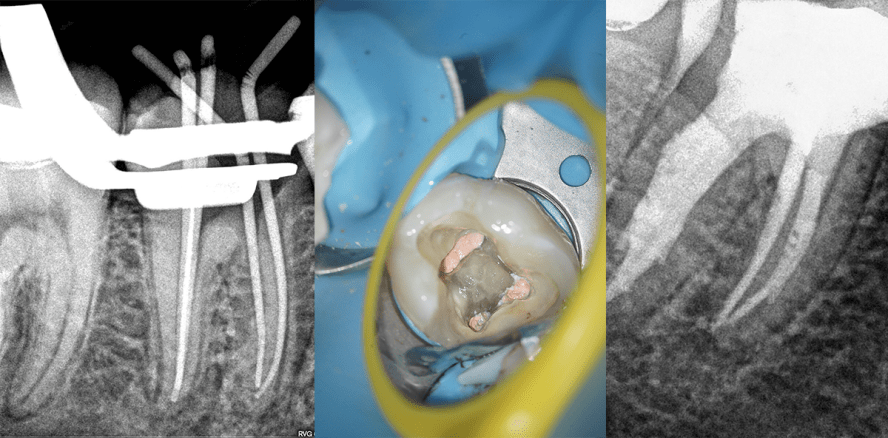Die Treppe zum Apex – Revision vorheriger Revisionen
