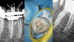 Die Treppe zum Apex – Revision vorheriger Revisionen