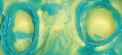 Die Basis für perfekte Prothetik