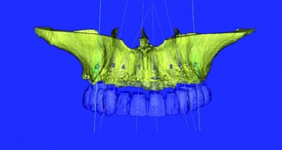 Navigierte Osteoplastik und Implantation