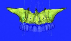 Navigierte Osteoplastik und Implantation