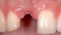 Implantation im Frontzahnbereich