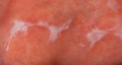 Der orale Lichen planus – ein Update