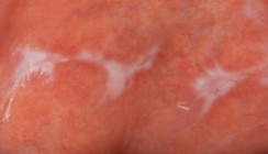 Der orale Lichen planus – ein Update