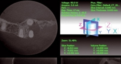 Therapieverfahren für Oberkiefermolaren