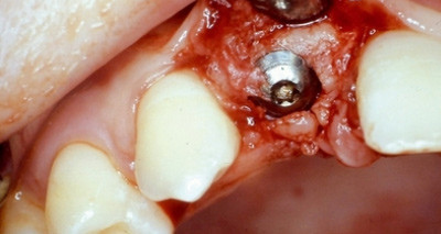 Nachhaltigkeit in der Implantologie