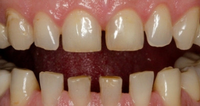 Der Zauber der Mikro-Veneers