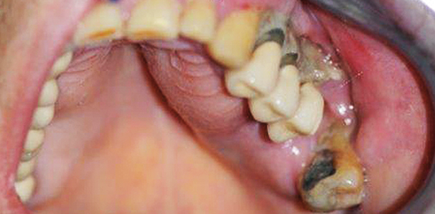 Patienten unter Tumortherapie