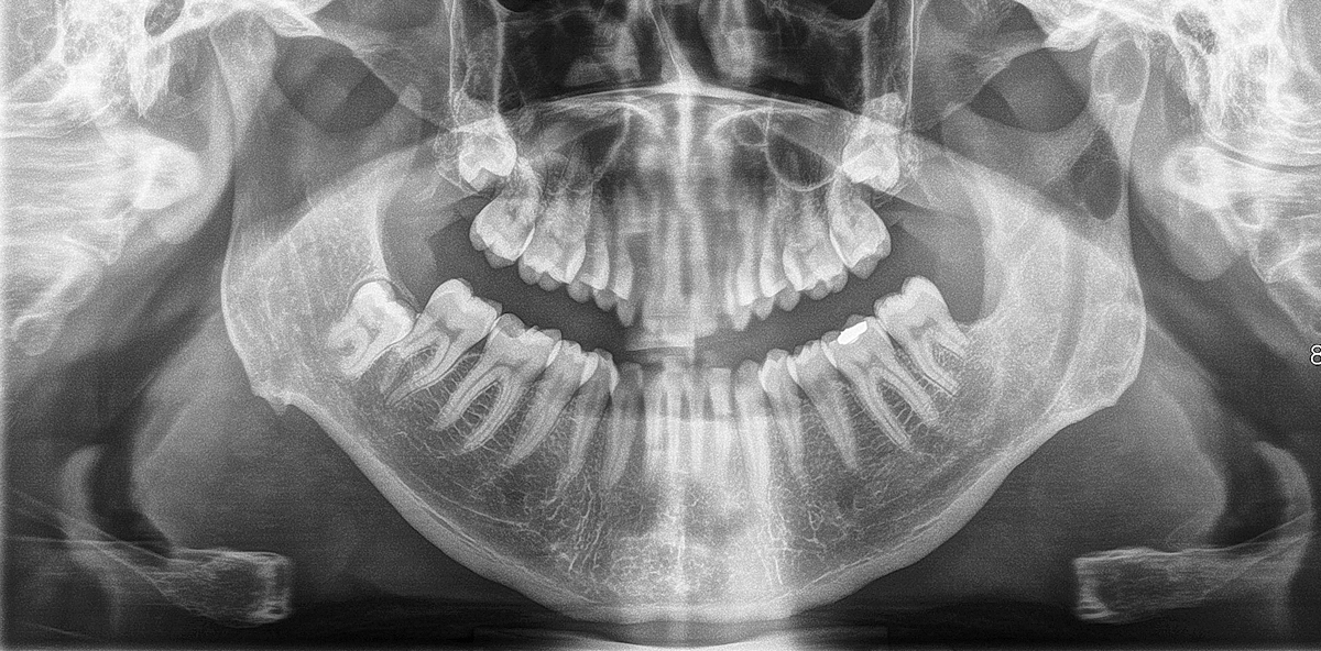 Im Kiefergelenk – odontogener Tumor in schwieriger Lage