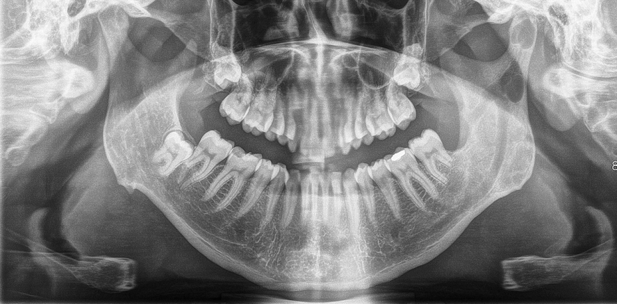 Im Kiefergelenk – odontogener Tumor in schwieriger Lage