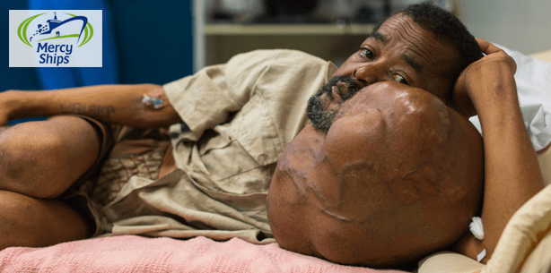 Dank Mercy Ships: Chirurgen entfernen 7,5 kg schweren Tumor
