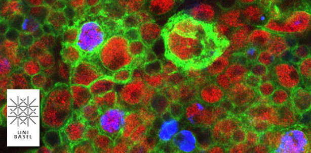 Wie Hirntumore aus Stammzellen entstehen