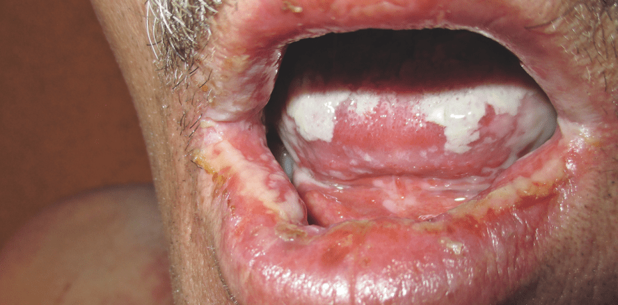 Patienten unter Tumortherapie