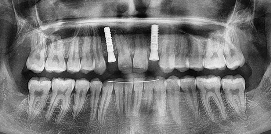 Augmentatives Relining – Ein kombiniertes Verfahren