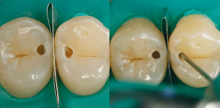 Zwei tunnelierte Füllungen