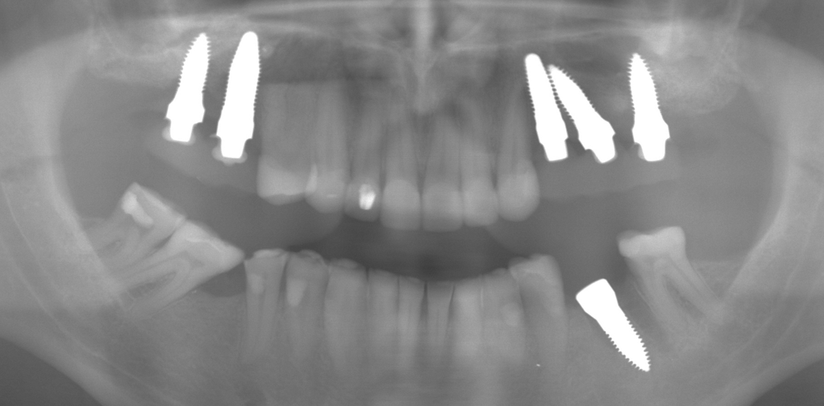 Titanexplantation mit sofortiger Zirkonimplantation