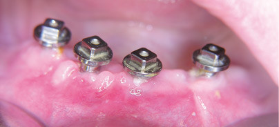 Sofortbelastung im Unterkiefer bei Zahnlosigkeit