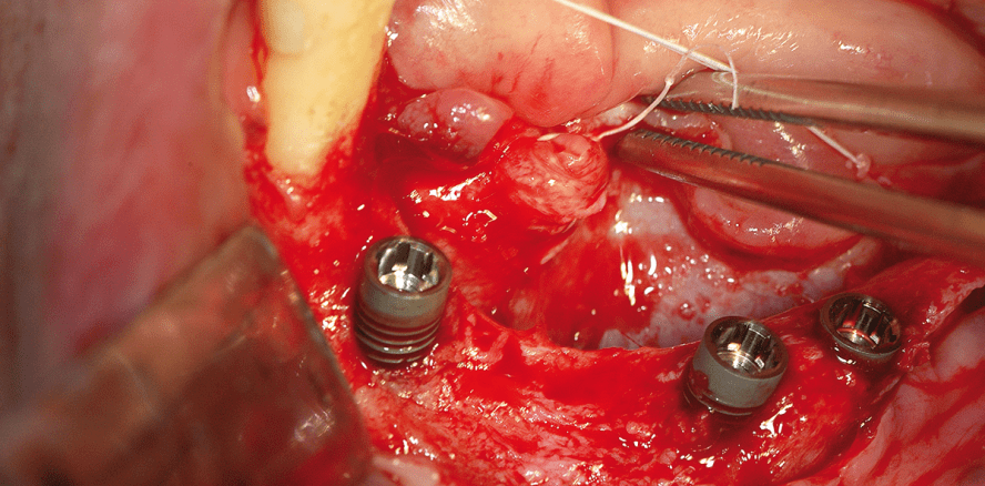 Vertikale Kieferkammaugmentation eines stark resorbierten anterioren Unterkiefers