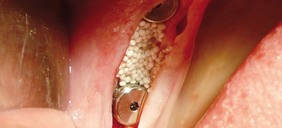 Ultraschallchirurgie: Neue Möglichkeiten in Oralchirurgie und Implantologie