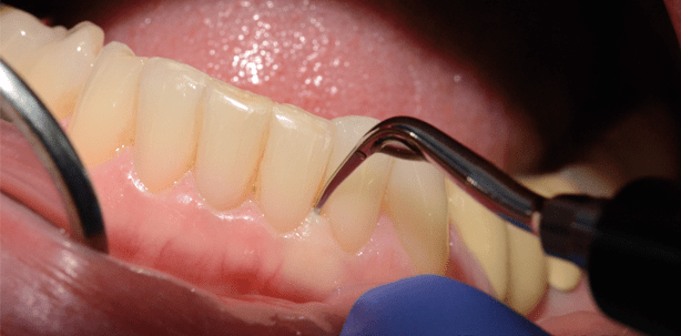 Schall versus Ultraschall