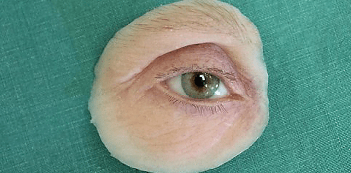 Kurze Implantate mit hydrophiler Oberfläche als Verankerungselemente von Orbitaepithesen