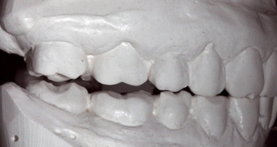 Komplexe Restauration –  non- und minimalinvasiv