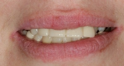 Progenie funktionell und ästhetisch behoben