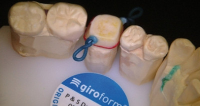 Störungsfreies okklusales Relief mithilfe der FGP-Technik