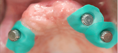 Anatomie einer Konuskrone