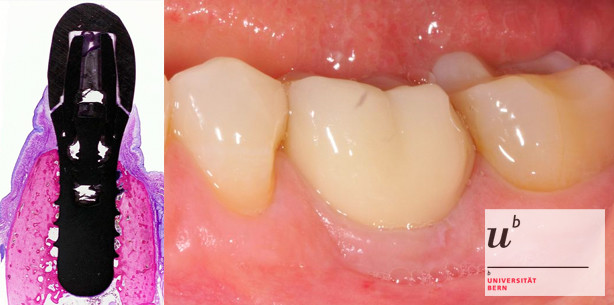 Forscher belegen Zuverlässigkeit von Implantaten