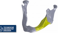 Weltweit erstes individuelles Unterkieferimplantat entwickelt