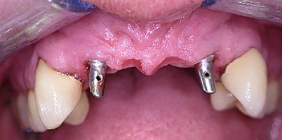 Vorhersagbare Implantatbehandlung in der täglichen Praxis