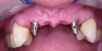 Vorhersagbare Implantatbehandlung in der täglichen Praxis