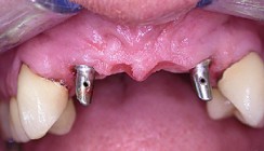 Vorhersagbare Implantatbehandlung in der täglichen Praxis