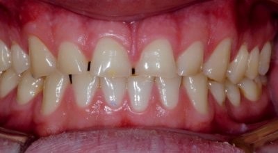 Bisshebung und No Prep Veneers – ein Widerspruch?