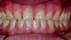 Bisshebung und No Prep Veneers – ein Widerspruch?