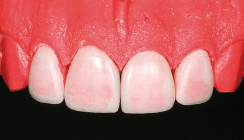 Minimalinvasive Veneerversorgung mit keramisch basiertem Füllungsmaterial