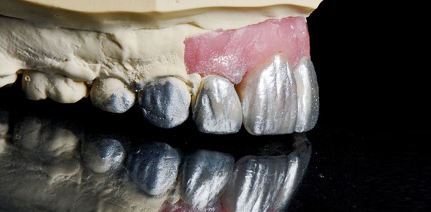 Noninvasive Veneerversorgung im Frontzahnbereich