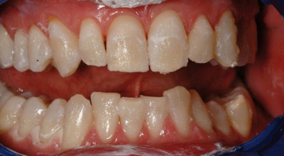 Zähne zeigen mit Veneers