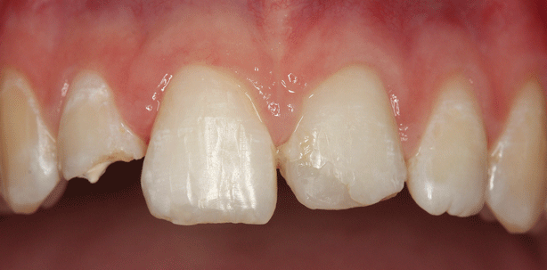 Restaurationen mit vollkeramischen Veneers nach Frontzahntrauma