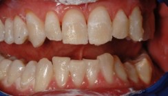 Zähne zeigen mit Veneers