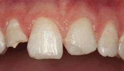 Restaurationen mit vollkeramischen Veneers nach Frontzahntrauma