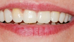 Mock-up-Technik für Veneerversorgungen