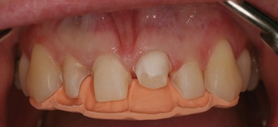 Korrektur von Zahnform und Zahnstellung mit keramischen Veneers