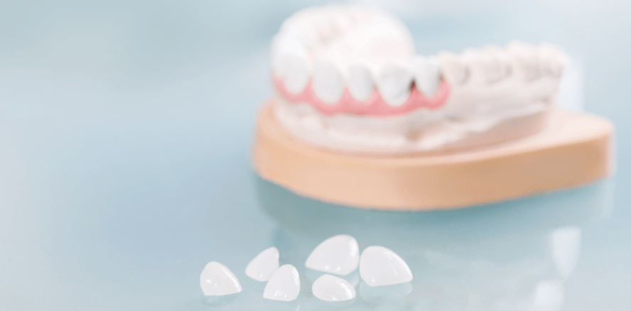 „Schwarze Dreiecke“ behandeln – Kronen, Veneers oder Komposite?