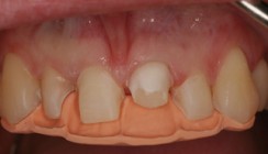 Korrektur von Zahnform und Zahnstellung mit keramischen Veneers