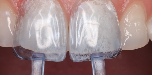 Präfabrizierte Kompositveneers – ein Fallbericht